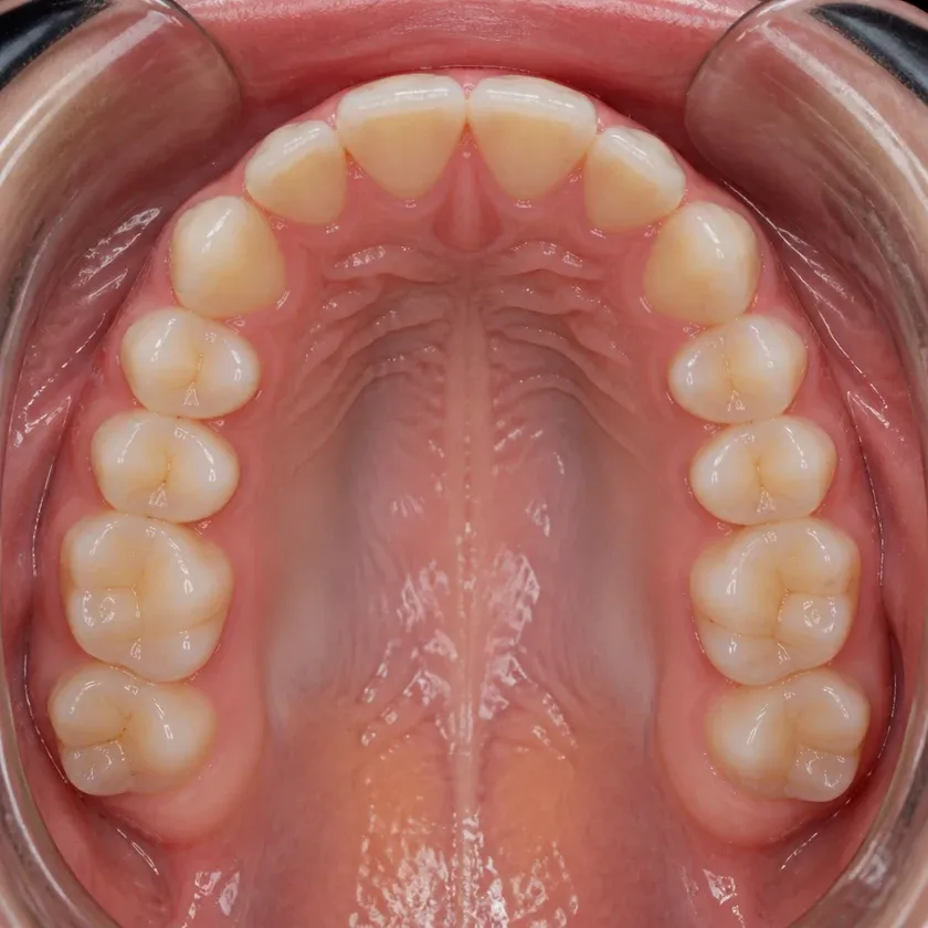 american orthodontics braces — close-up result after treatment on a clinical image