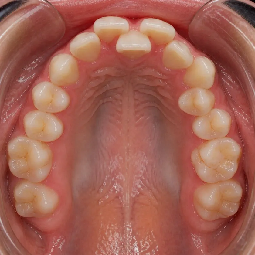 American Orthodontics braces — pre-treatment condition on a clinical image
