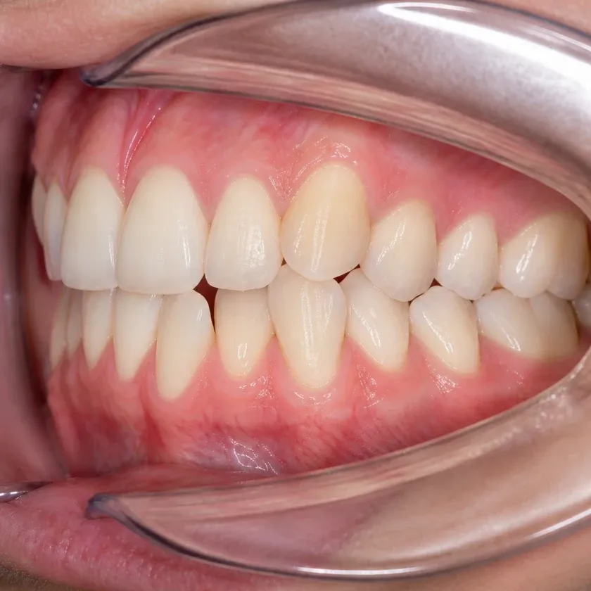 American Orthodontics braces — pre-treatment condition on a clinical image