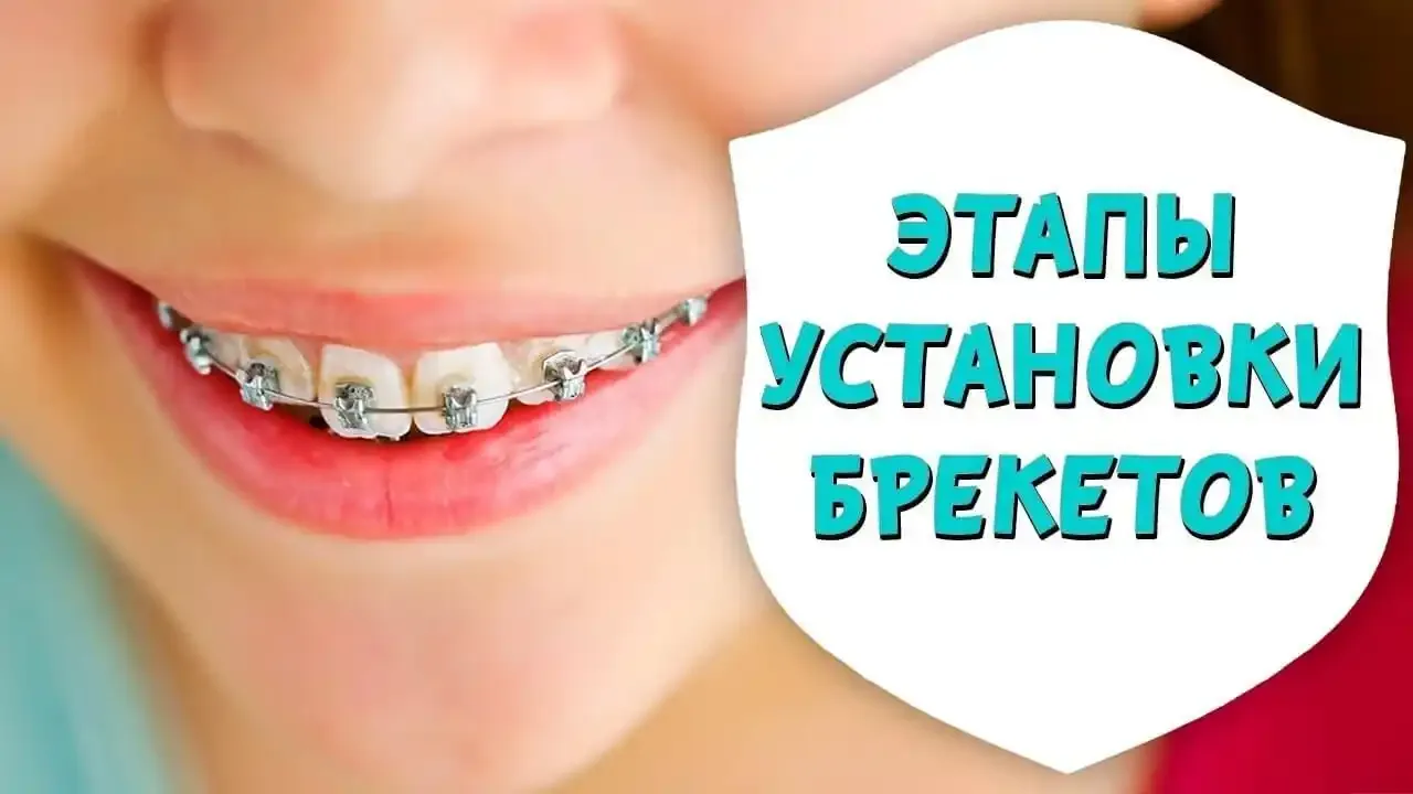 брекеттер қалай орнатылады