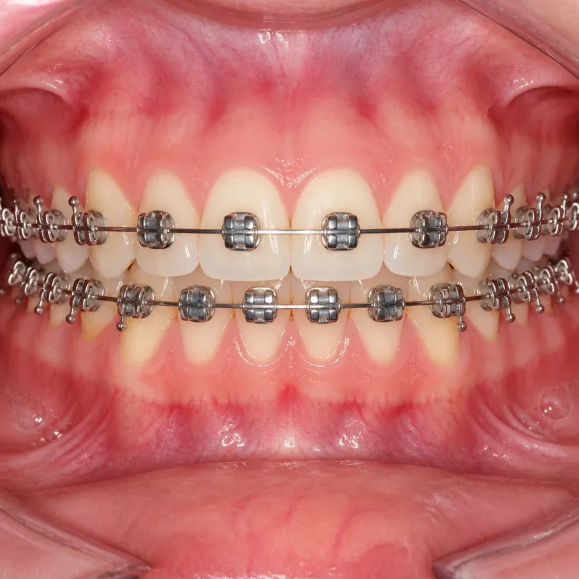metal bracket — close-up post-treatment clinical photograph