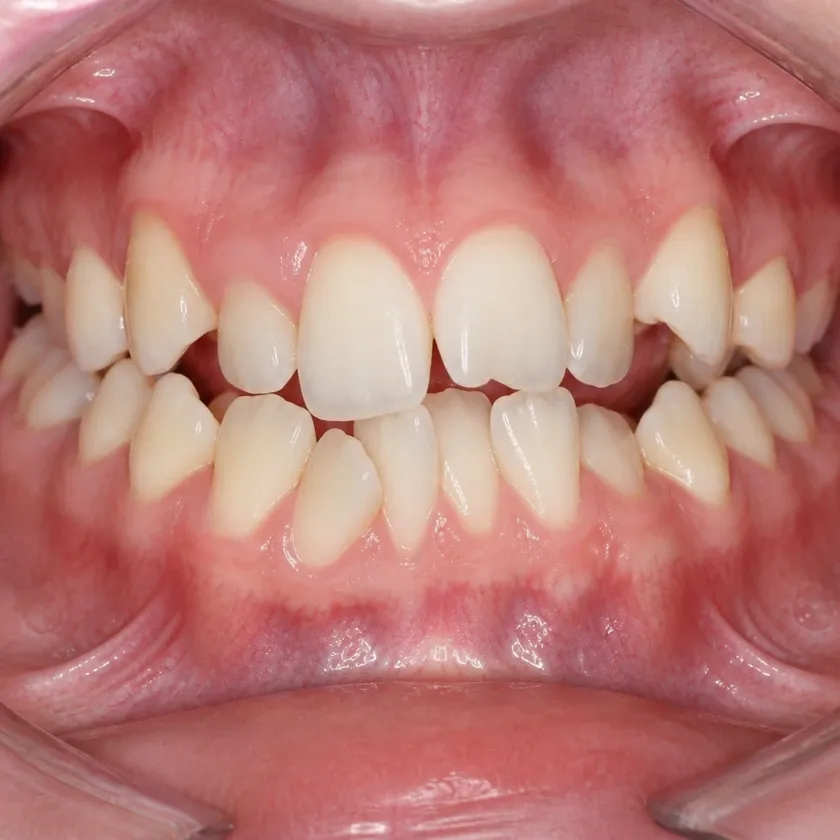 Metal braces — pre-treatment condition on a clinical image