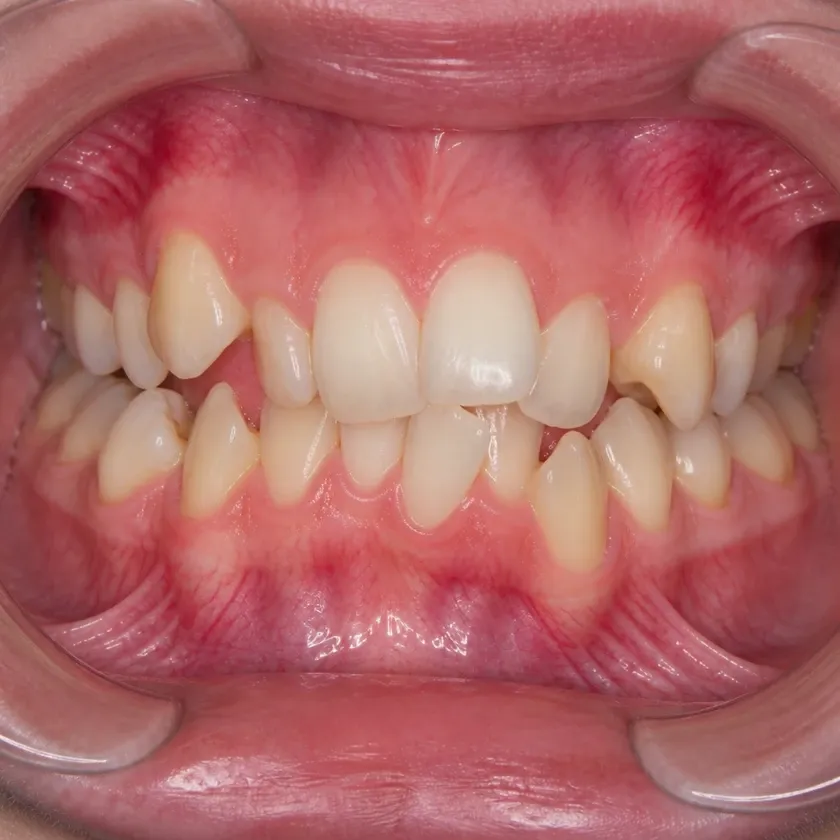 Metal braces — pre-treatment condition on a clinical image
