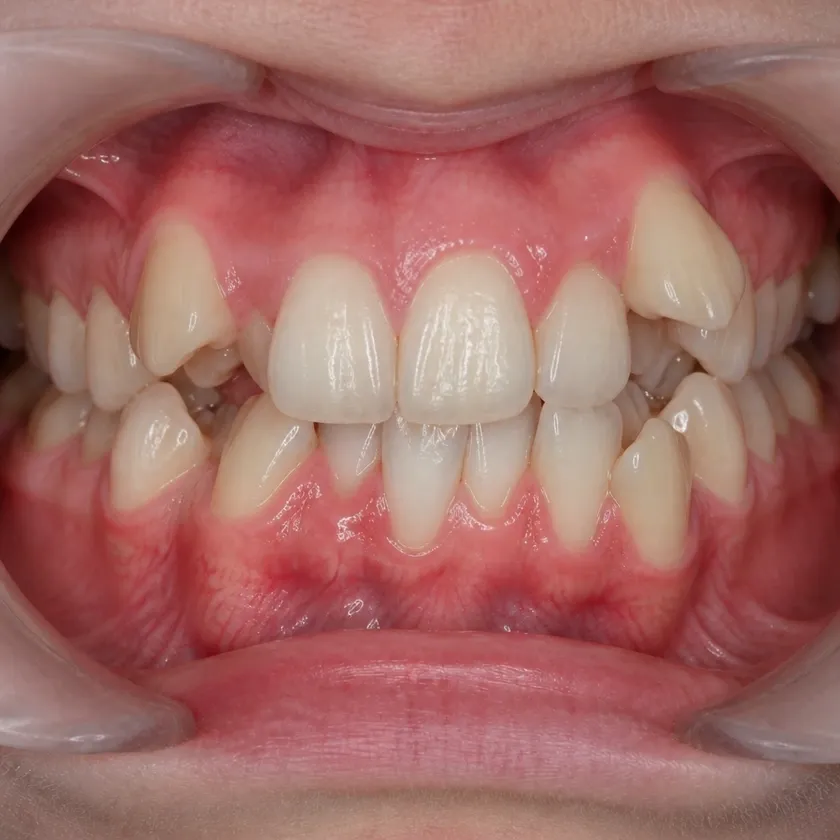 Metal braces — pre-treatment condition on a clinical image
