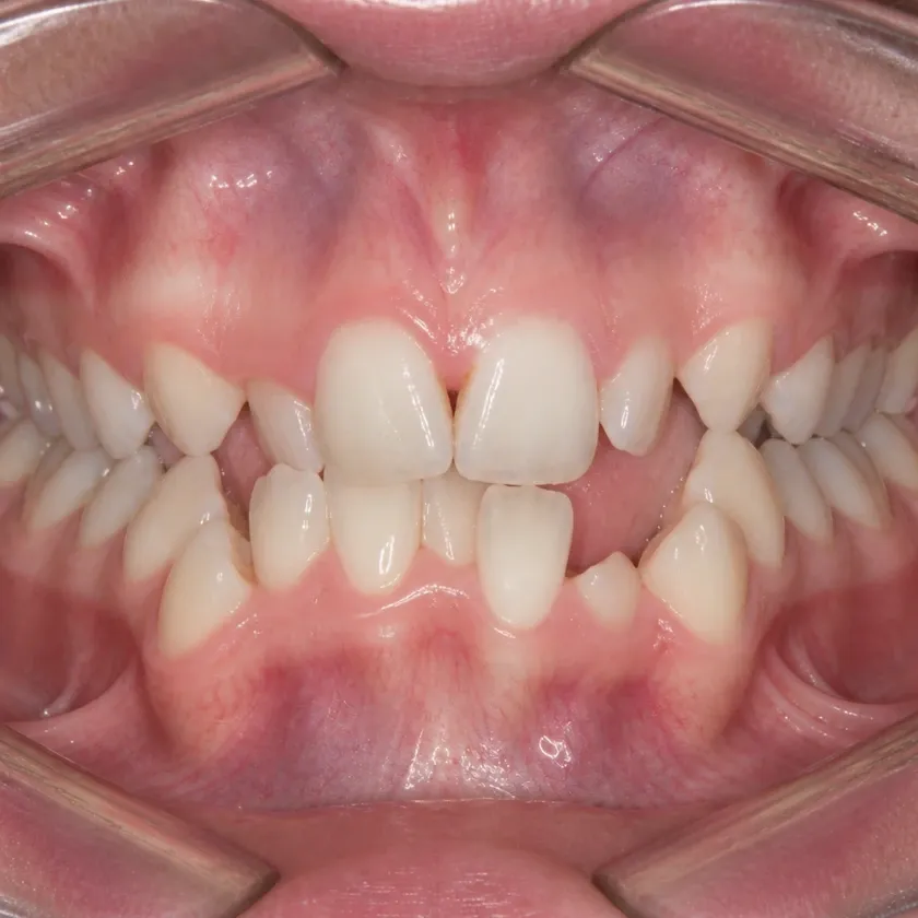 Metal braces — pre-treatment condition on a clinical image