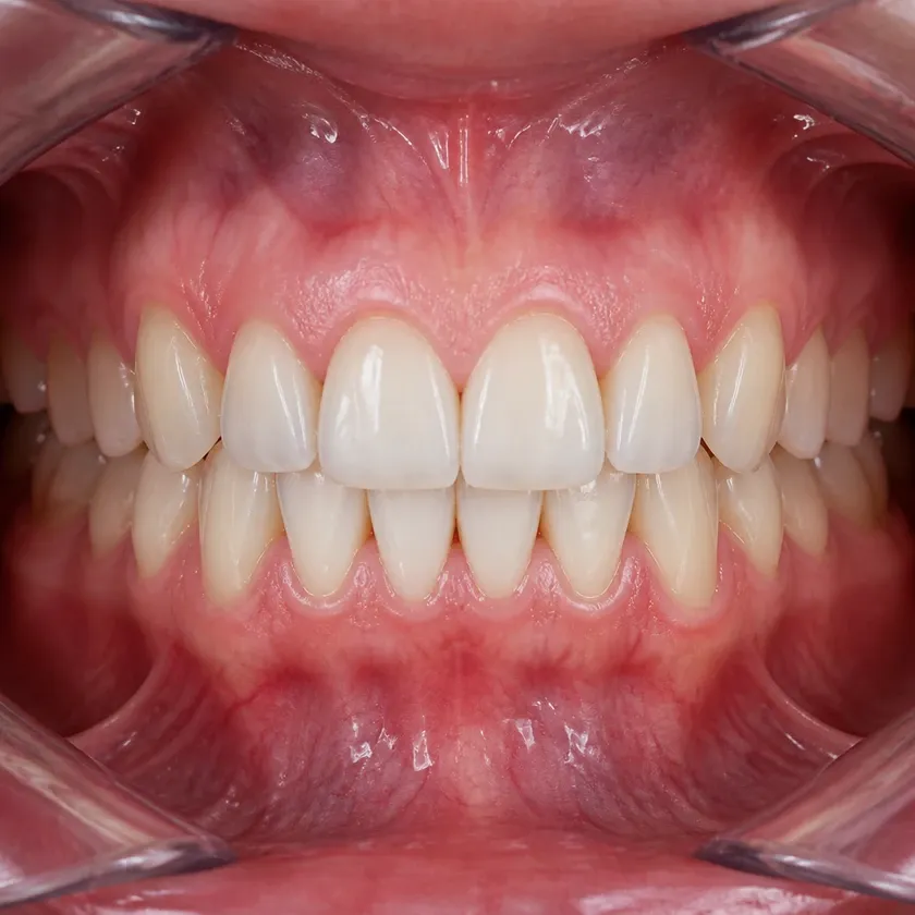 sapphire bracket — close-up of the result after treatment on a clinical photo