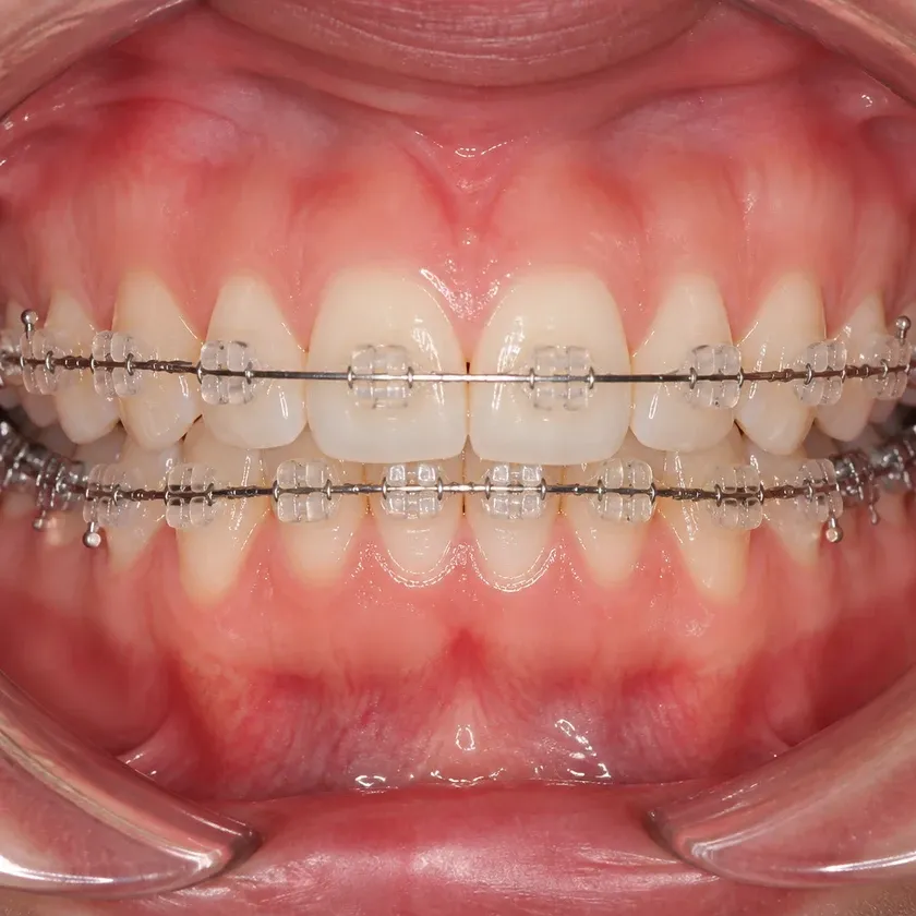 sapphire bracket — close-up of the result after treatment on a clinical photo