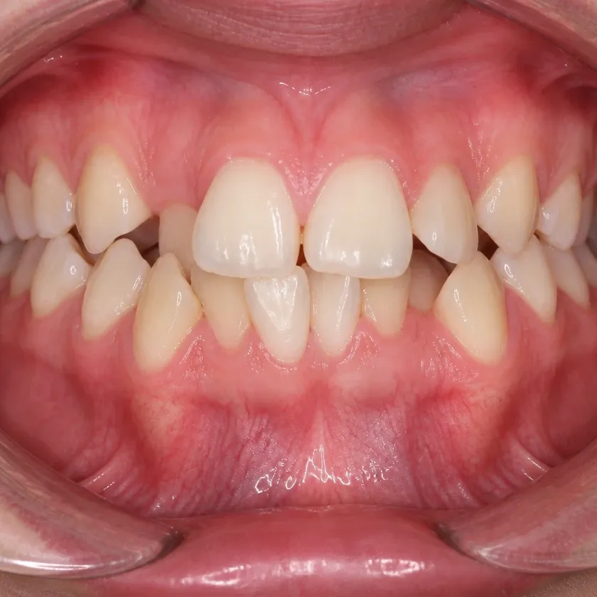 Sapphire braces — before treatment, clinical photograph
