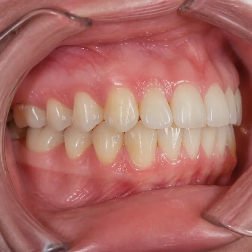 American Orthodontics braces — close-up clinical photo showing the result after treatment
