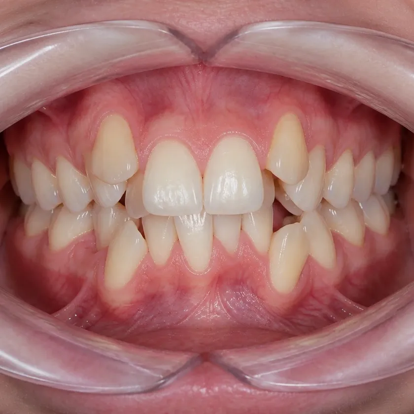 Braces — pre-treatment condition on the clinical image