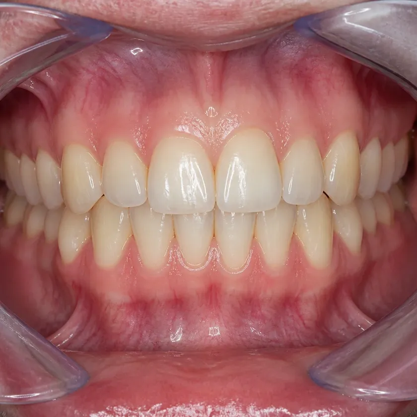 braces Astana — close-up result after treatment on a clinical image