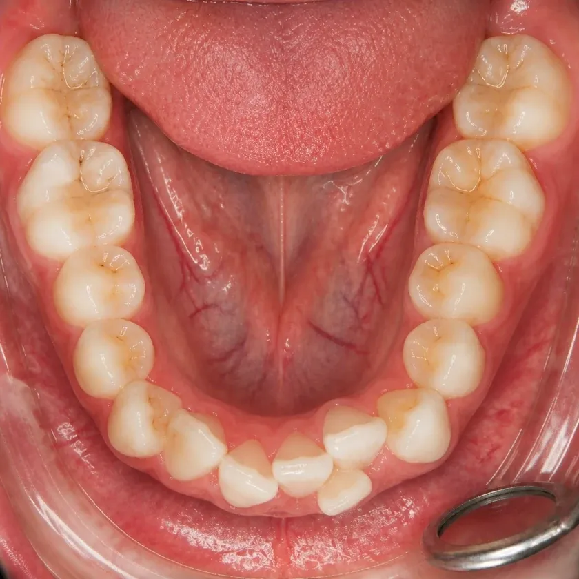 Braces — pre-treatment condition on the clinical image