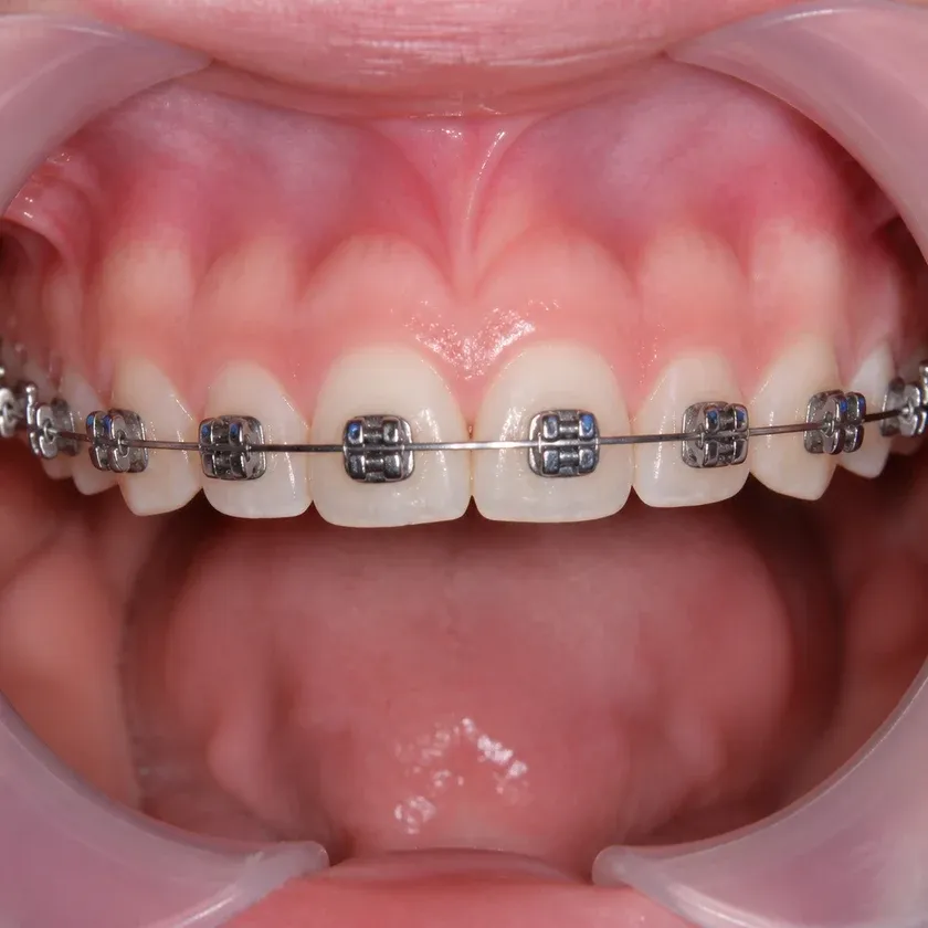 Braces — close-up of the treatment result on a clinical photograph
