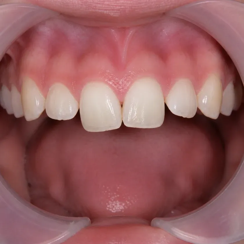 Braces — pre-treatment condition on the clinical image