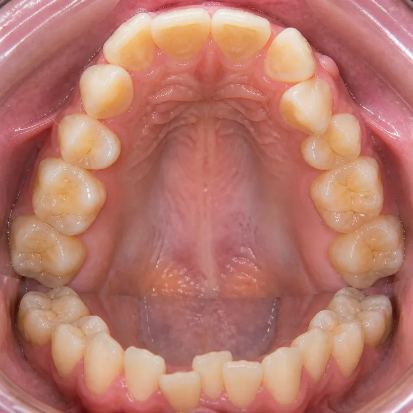 Braces — pre-treatment condition on the clinical image