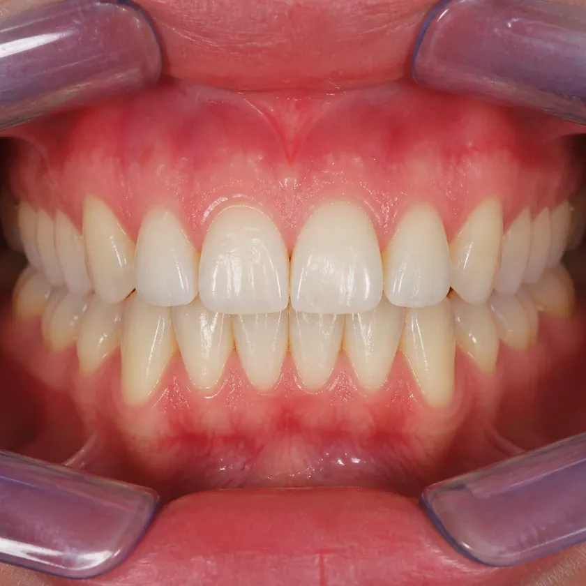damon braces astana — close-up result after treatment in a clinical photo