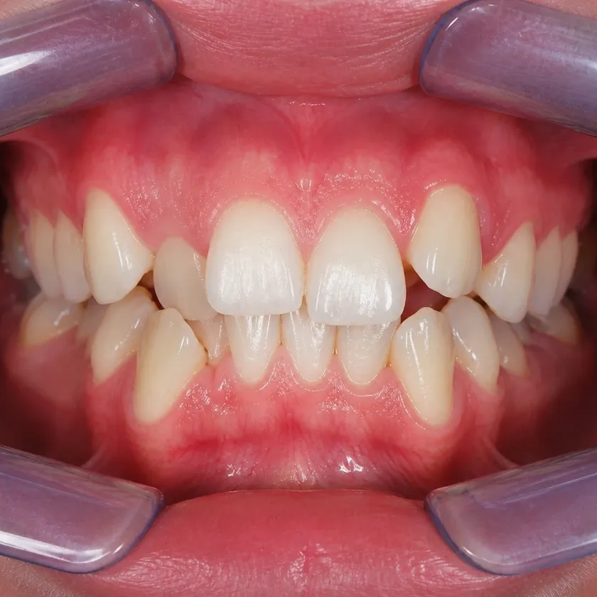 Damon braces — pre-treatment condition on a clinical image
