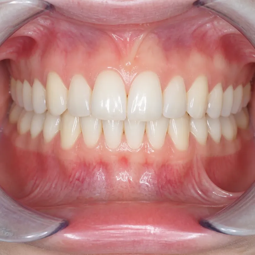 damon braces astana — close-up result after treatment in a clinical photo