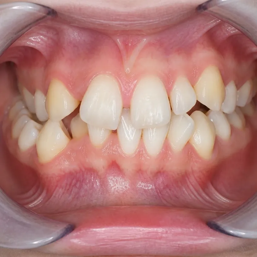 Damon braces — pre-treatment condition on a clinical image
