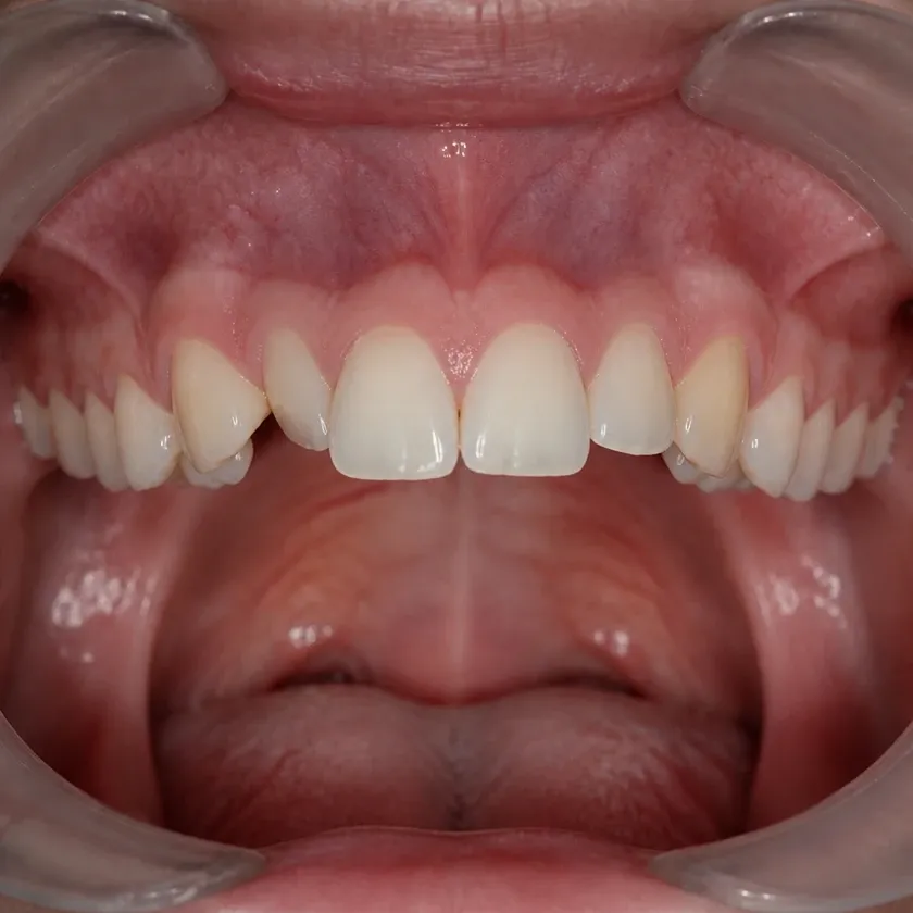 Damon braces — pre-treatment condition on a clinical image