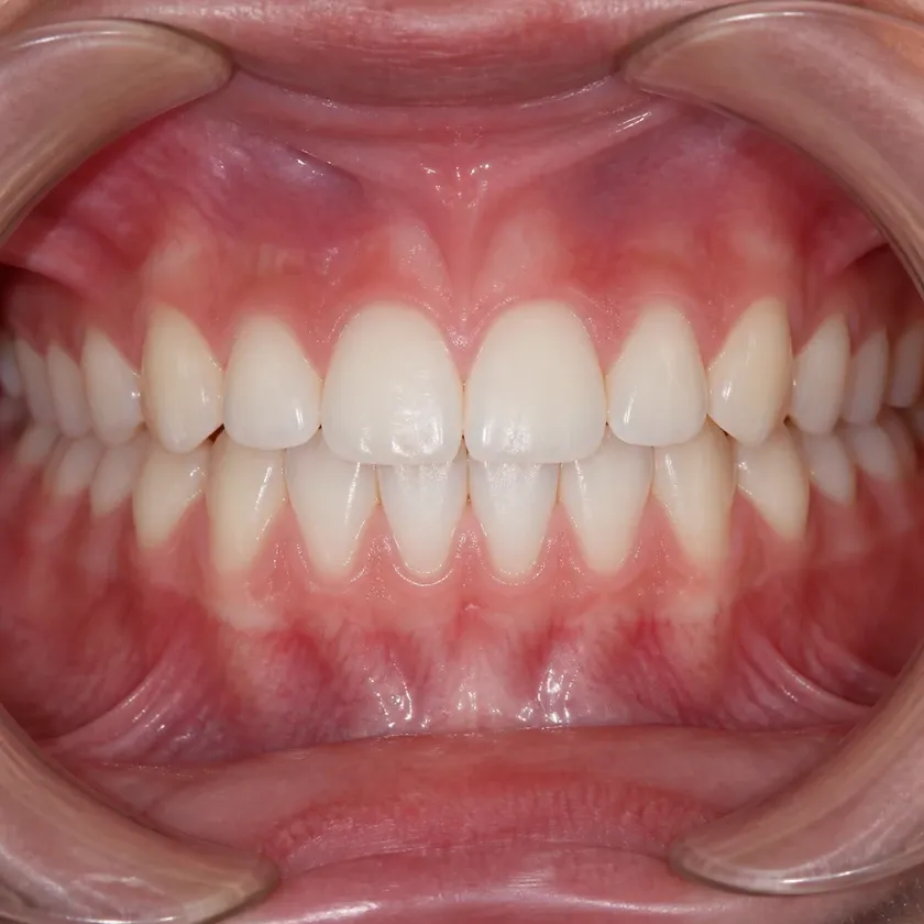 braces for children Astana — close-up of the result after treatment on a clinical image
