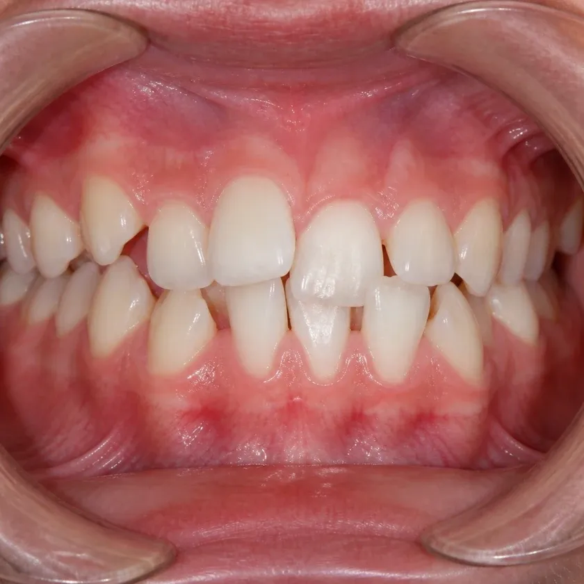 Braces for children — pre-treatment condition on a clinical image