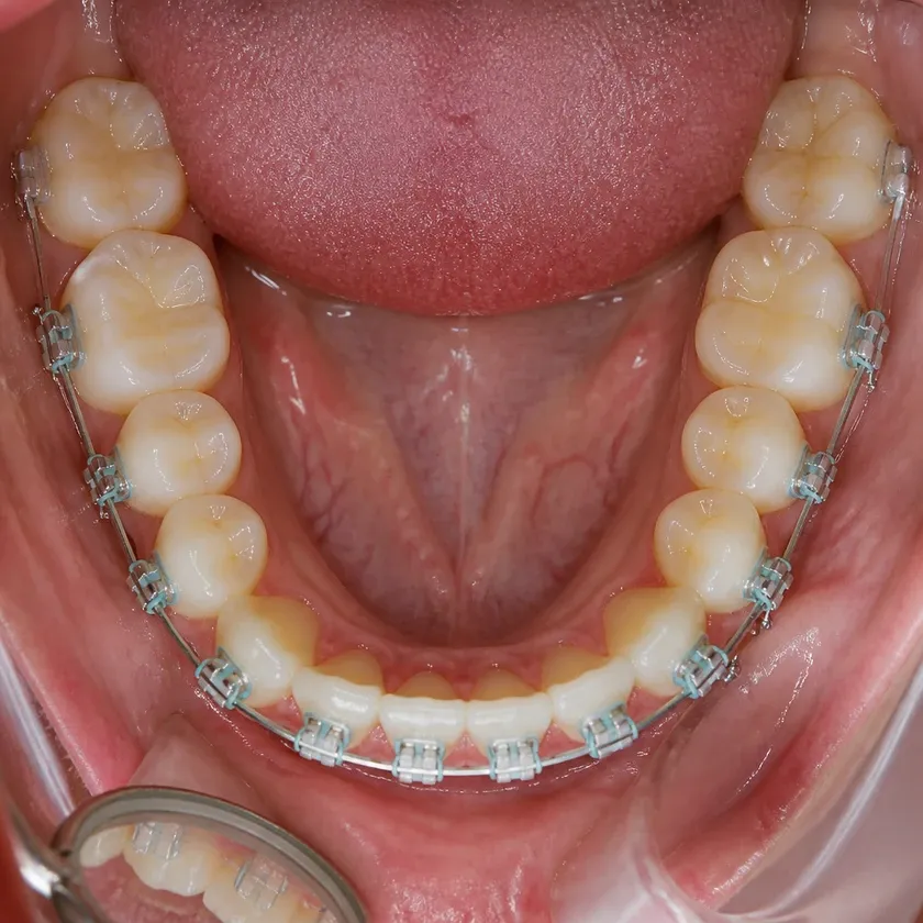Braces for children — close-up clinical photo of the result after treatment