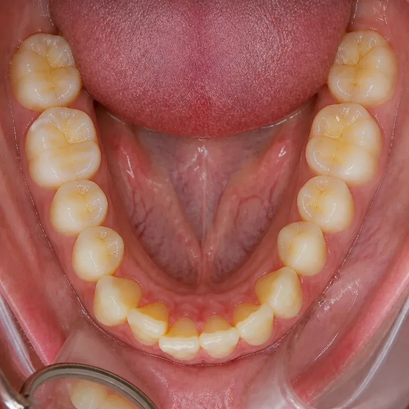 Braces for children — pre-treatment condition on a clinical image