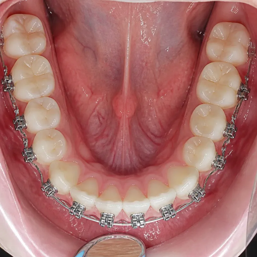 Braces for children — close-up clinical photo of the result after treatment
