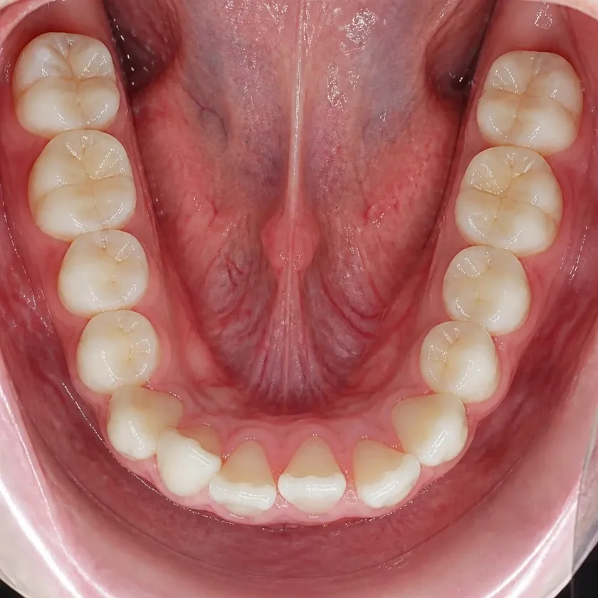 Braces for children — pre-treatment condition on a clinical image