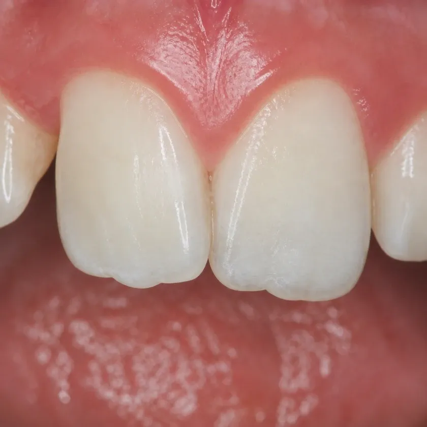 Braces for children — pre-treatment condition on a clinical image