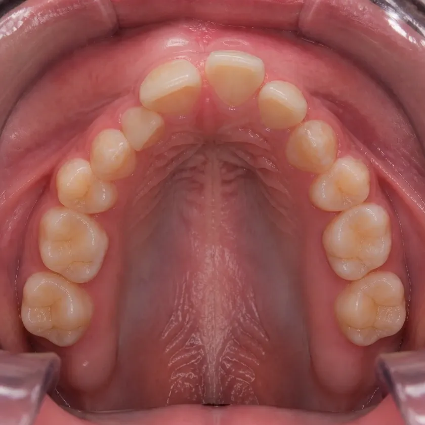 Braces for children — pre-treatment condition on a clinical image