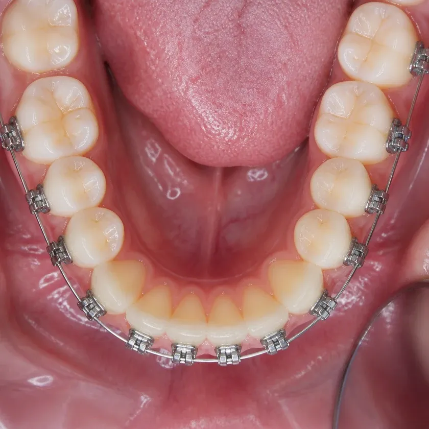 Forestadent braces — close-up clinical photo of the result after treatment