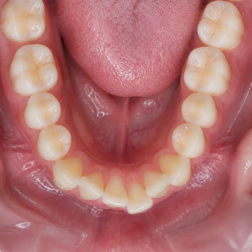 Forestadent braces — pre-treatment condition on a clinical image