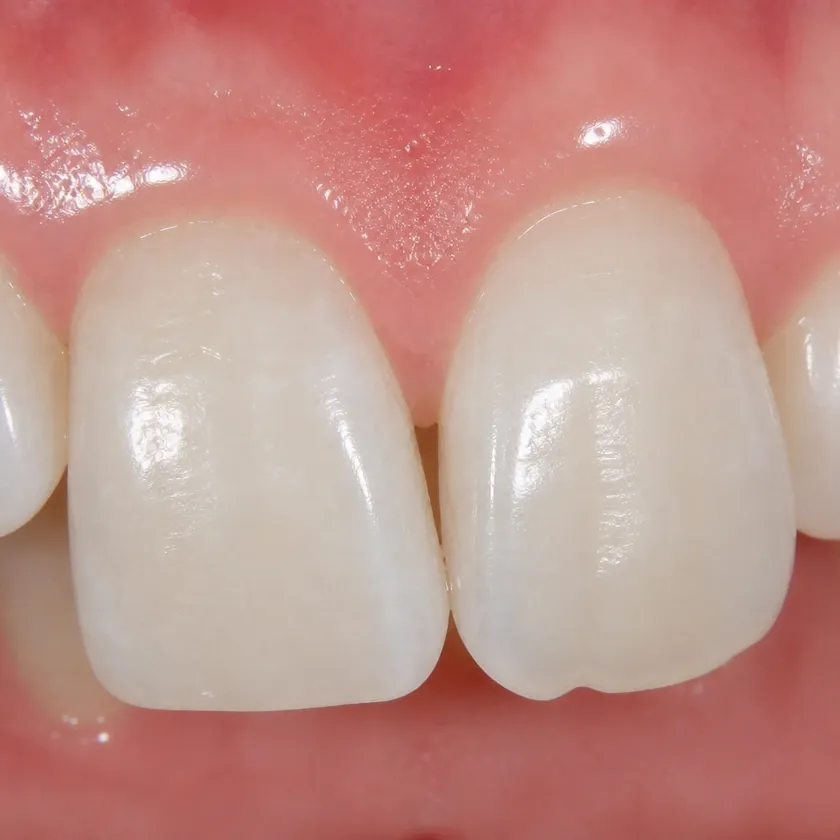 Forestadent braces — pre-treatment condition on a clinical image