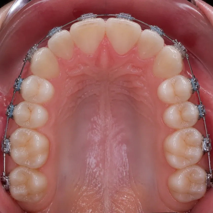 Forestadent braces — close-up clinical photo of the result after treatment