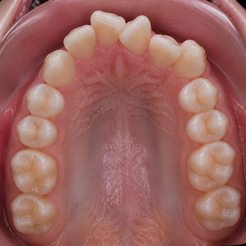 Forestadent braces — pre-treatment condition on a clinical image