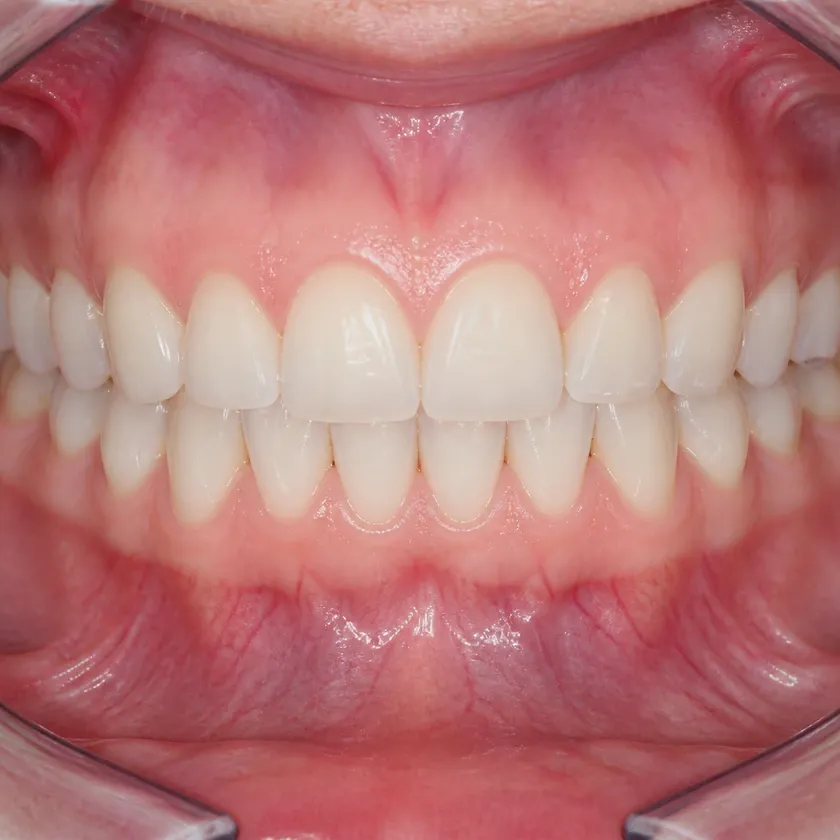 morelli braces astana — close-up result after treatment in a clinical photo