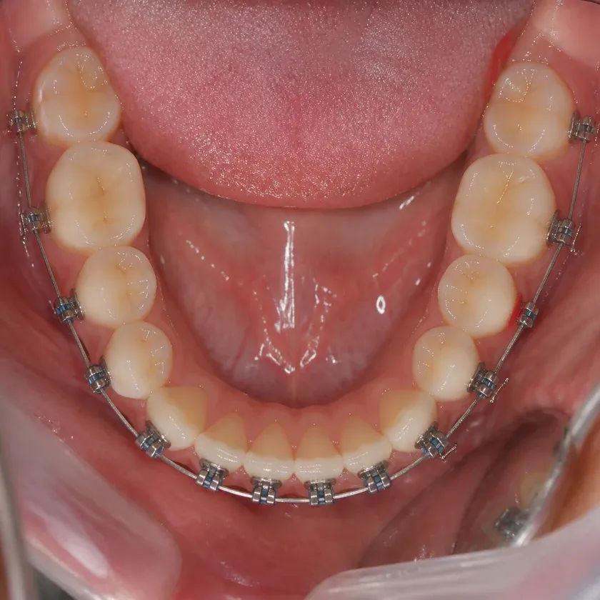 Morelli braces — close-up clinical photo of the result after treatment