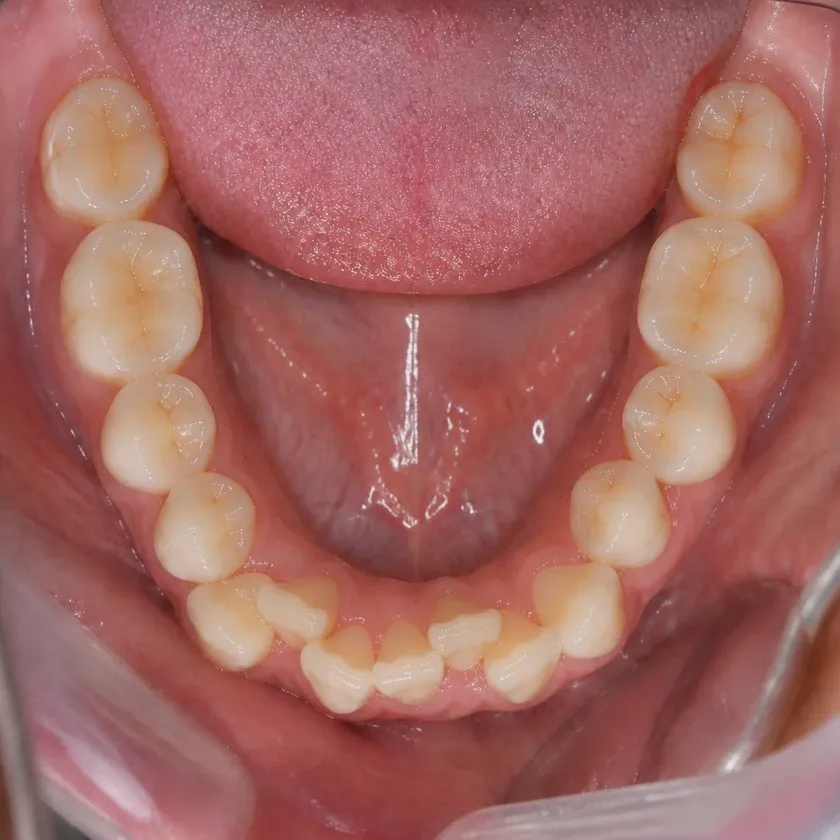 Morelli braces — pre-treatment condition in the clinical photograph