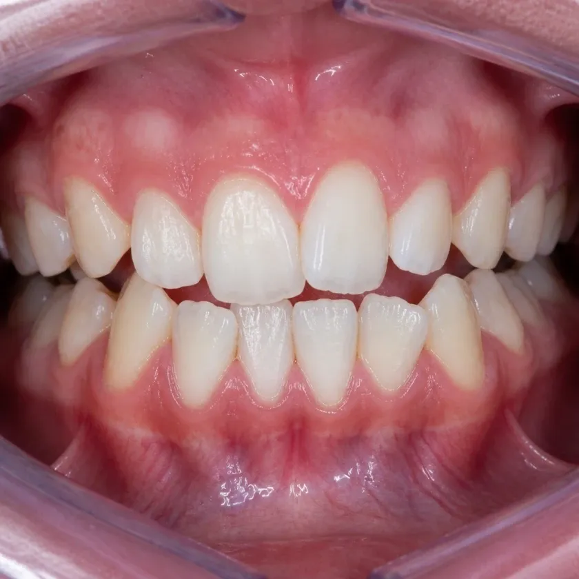 Morelli braces — pre-treatment condition in the clinical photograph