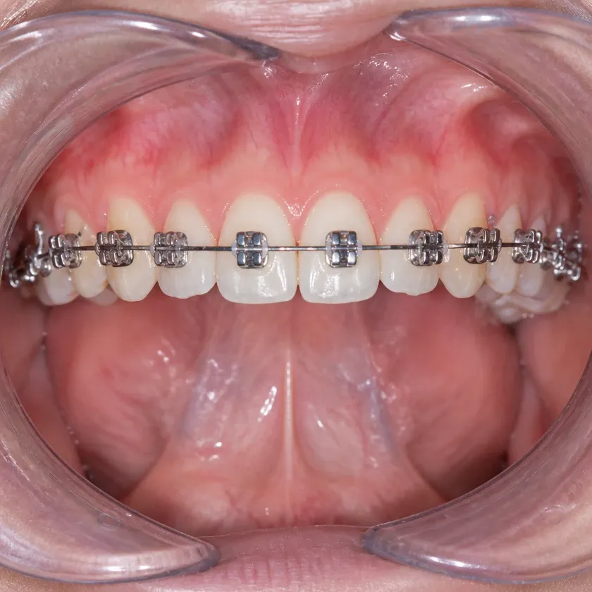 Morelli braces — close-up of the treatment result in a clinical photograph