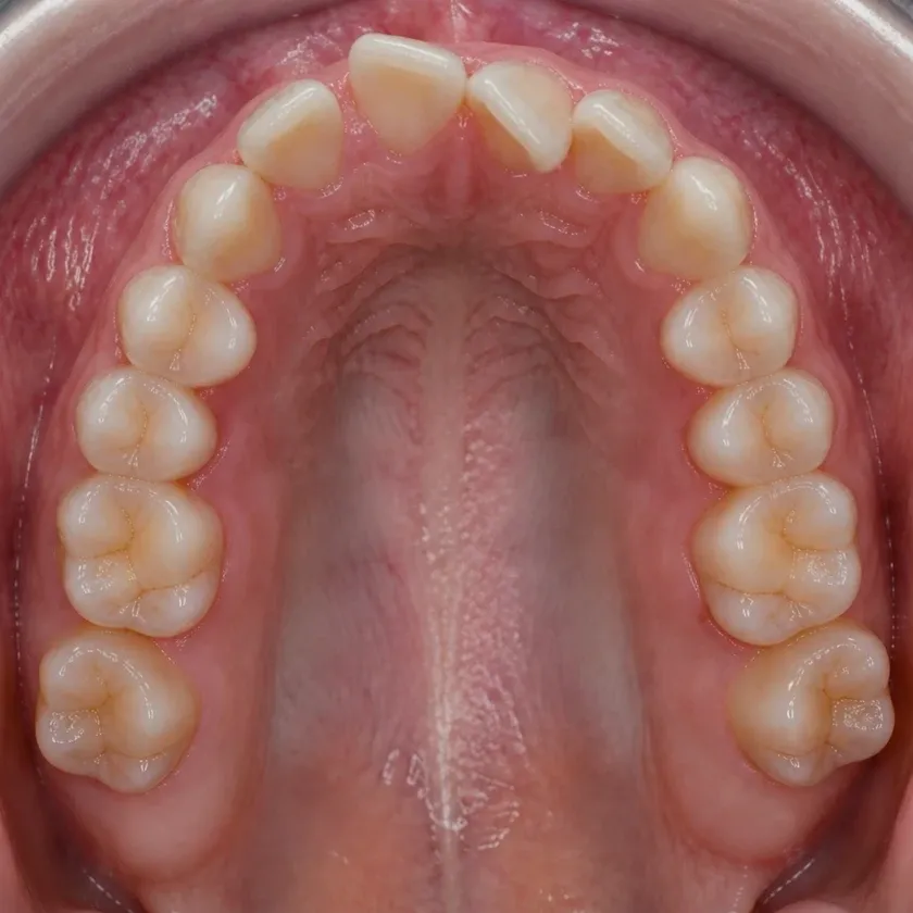 Morelli braces — pre-treatment condition in the clinical photograph