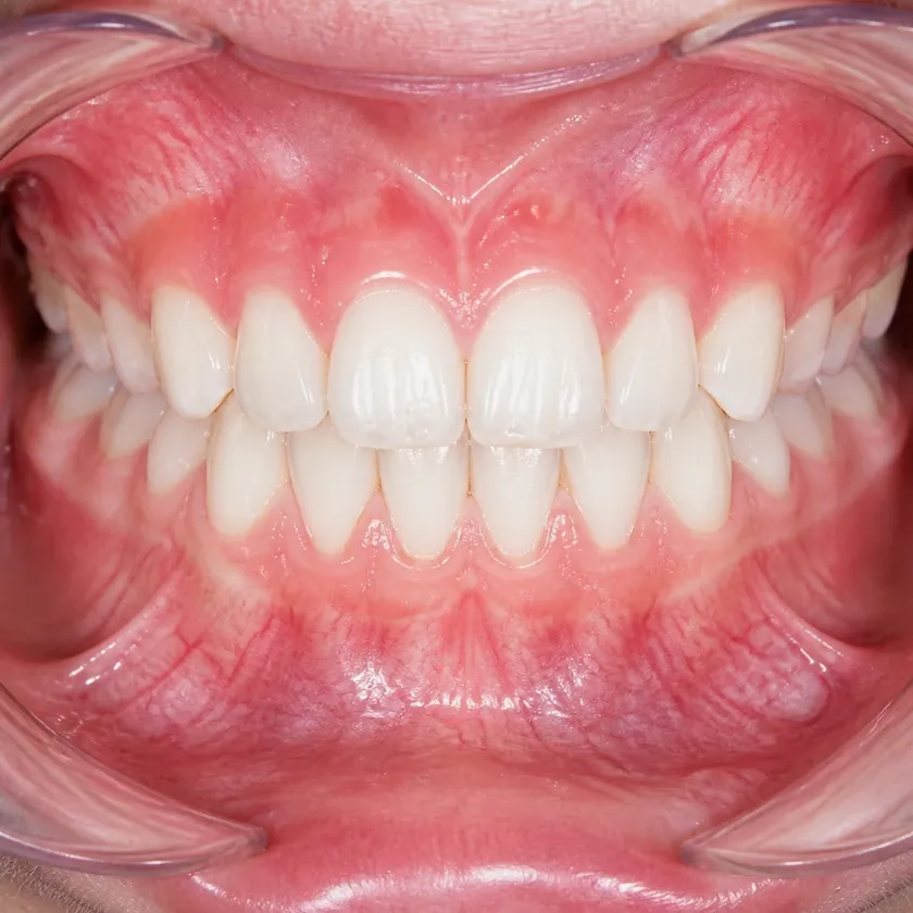 children's dental plate price — close-up of the result after treatment in a clinical photograph