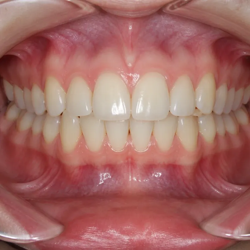 children's dental plate price — close-up of the result after treatment in a clinical photograph