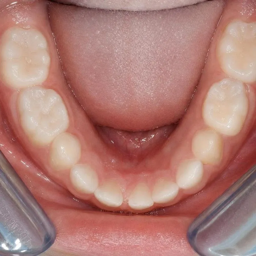 Primary molars with white fillings after treatment