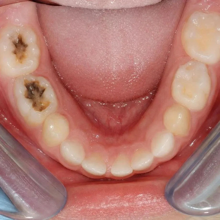 Carious cavities on two primary molars