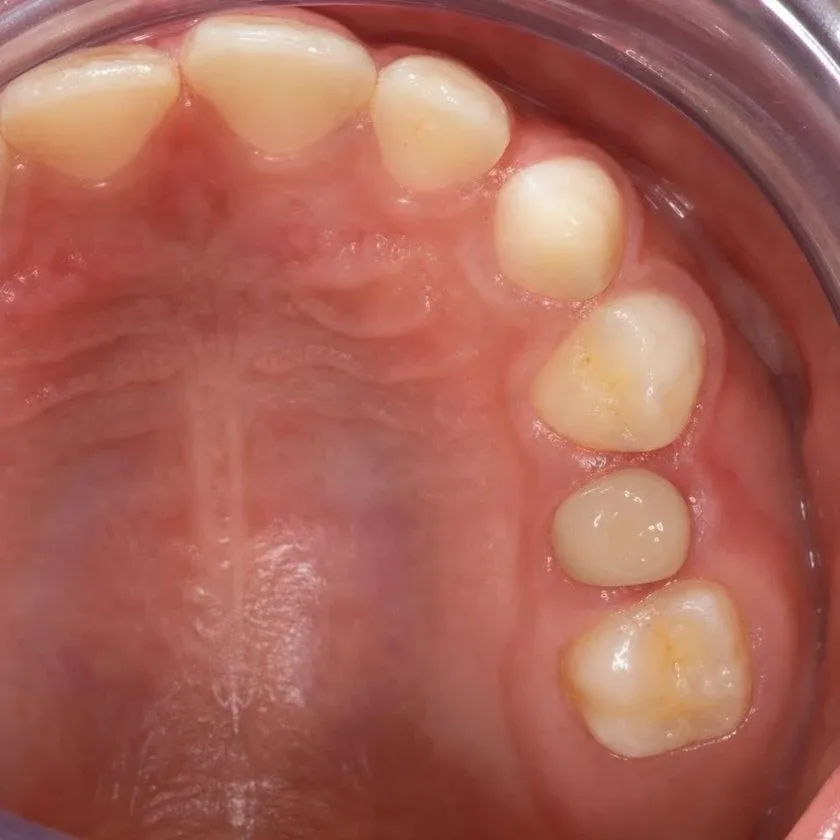 Pediatric crown on a primary molar