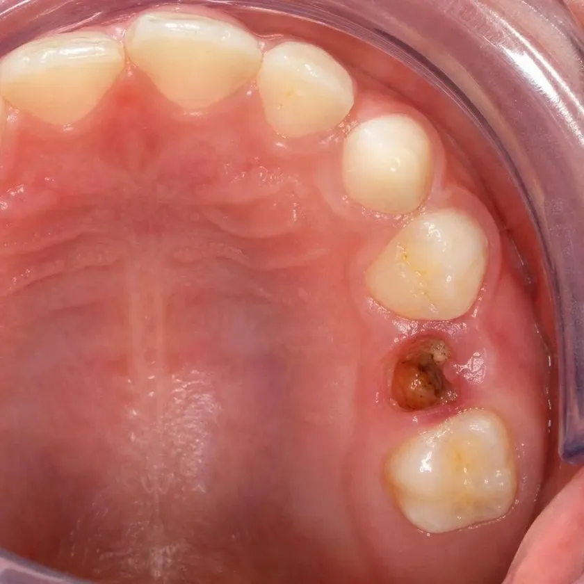 Severely decayed primary molar