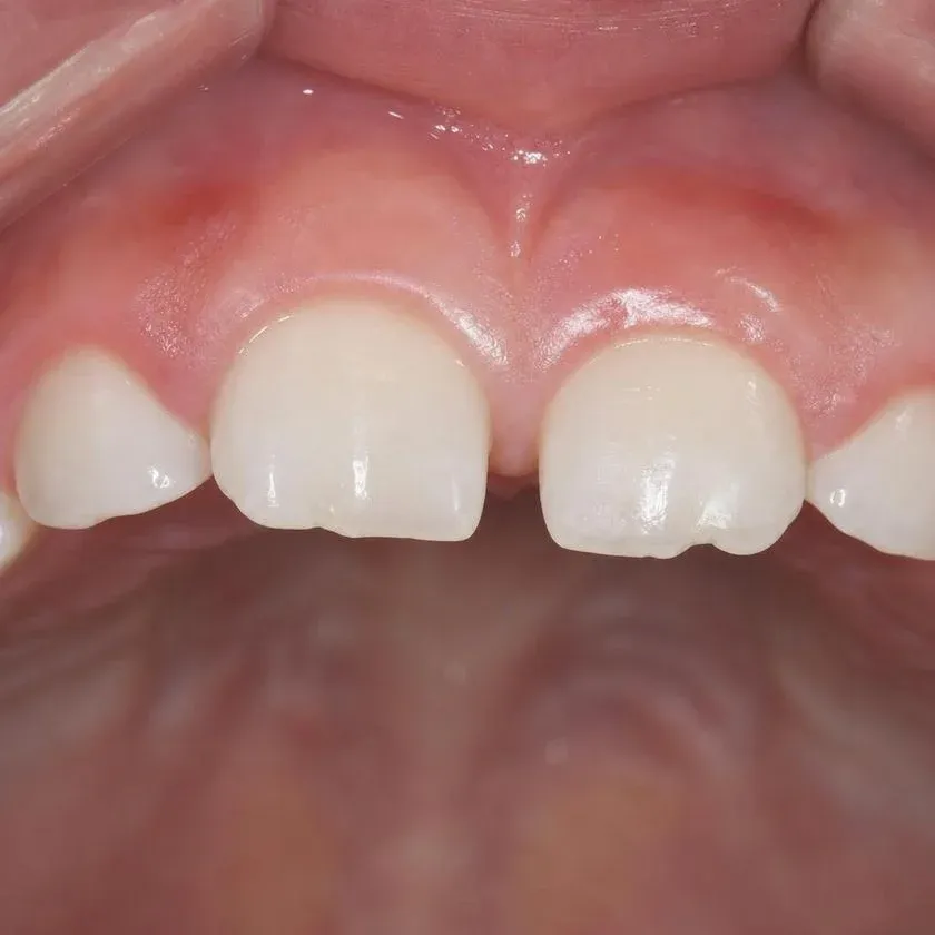 Smooth enamel of the front teeth after remineralization